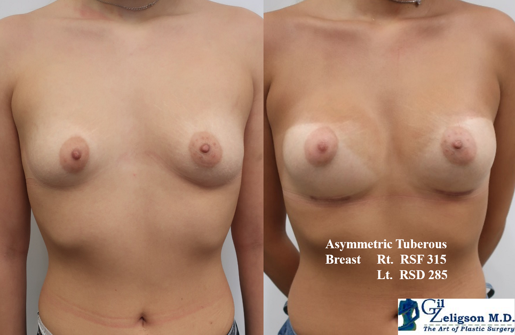 Dr. Gil Zeligson - Breast Asymmetry Correction
