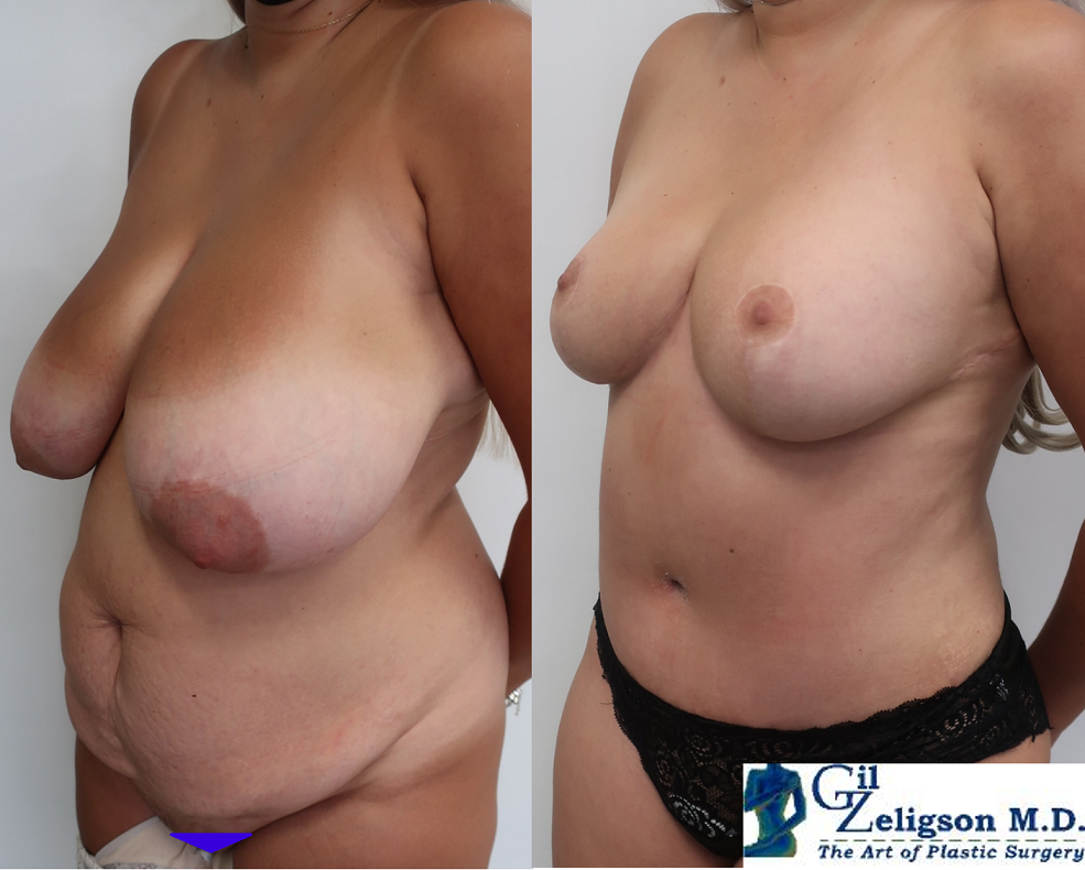 Dr. Gil Zeligson - Tummy Tuck Abdomino plasty