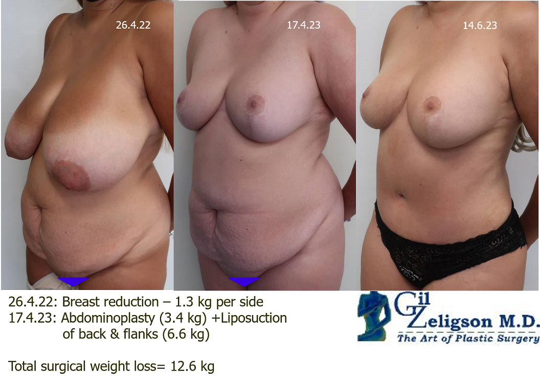Dr. Gil Zeligson - Tummy Tuck Abdomino plasty