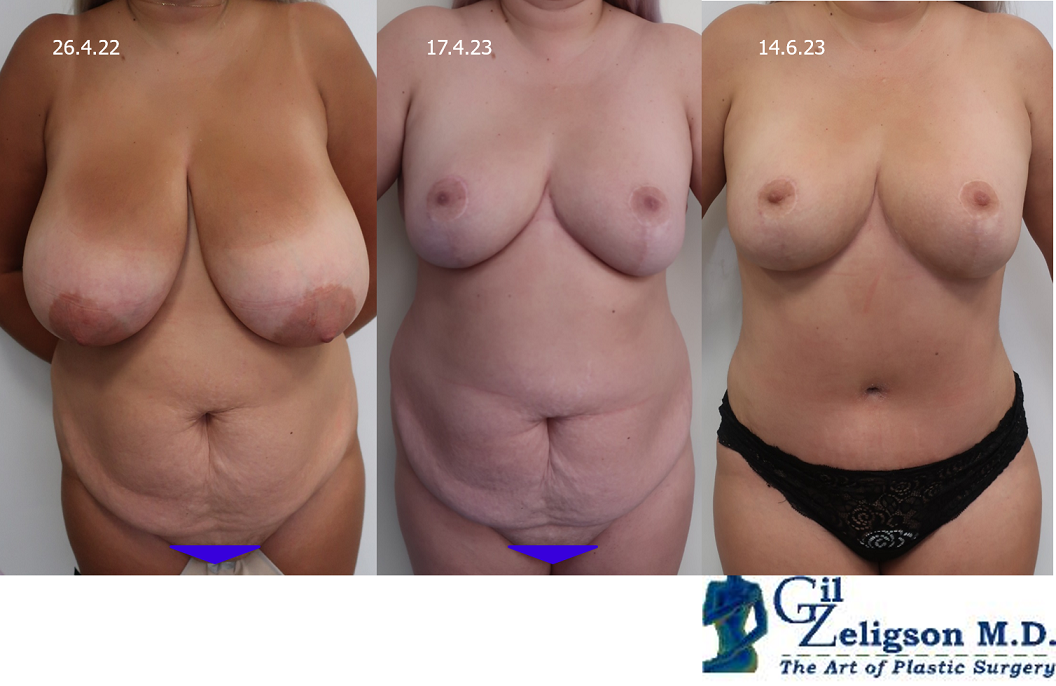 Dr. Gil Zeligson - Tummy Tuck Abdomino plasty