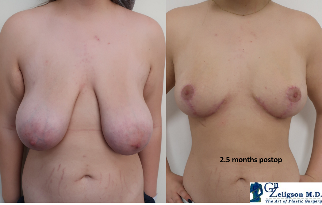 Dr. Gil Zeligson - Breast Reduction