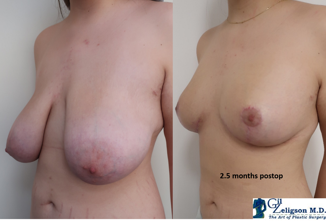 Dr. Gil Zeligson - Breast Reduction