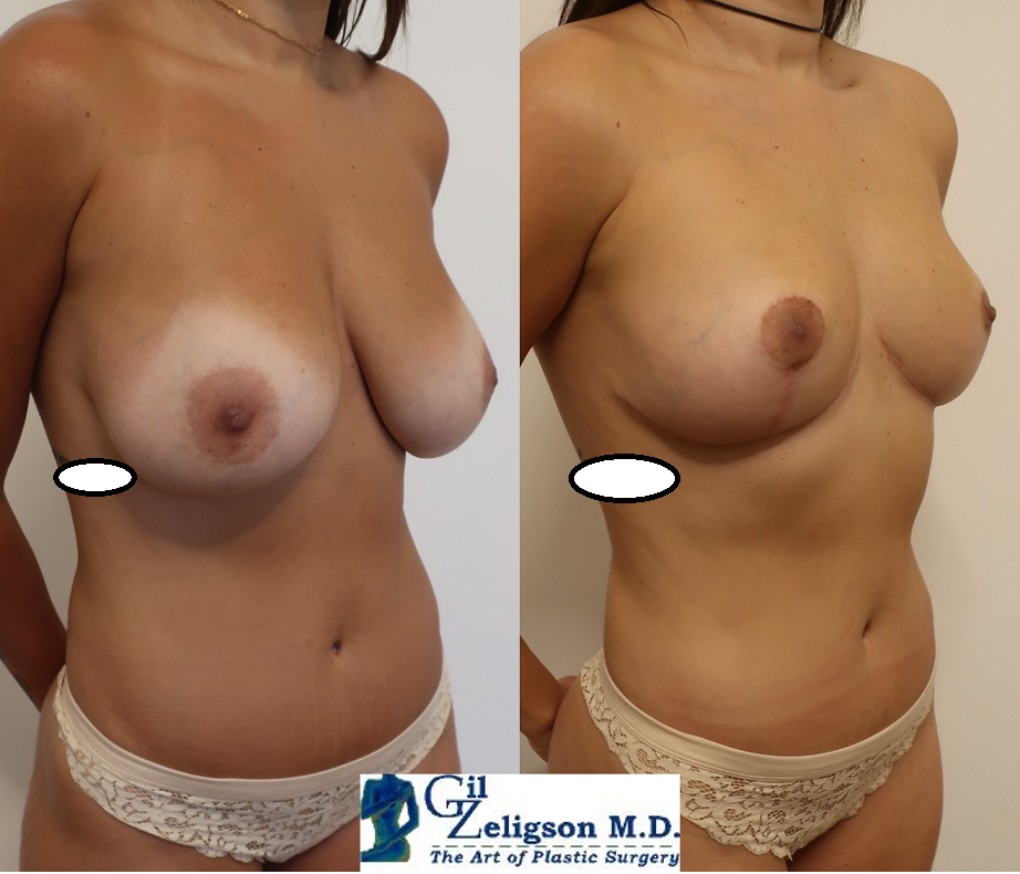 Dr. Gil Zeligson - Breast Reduction