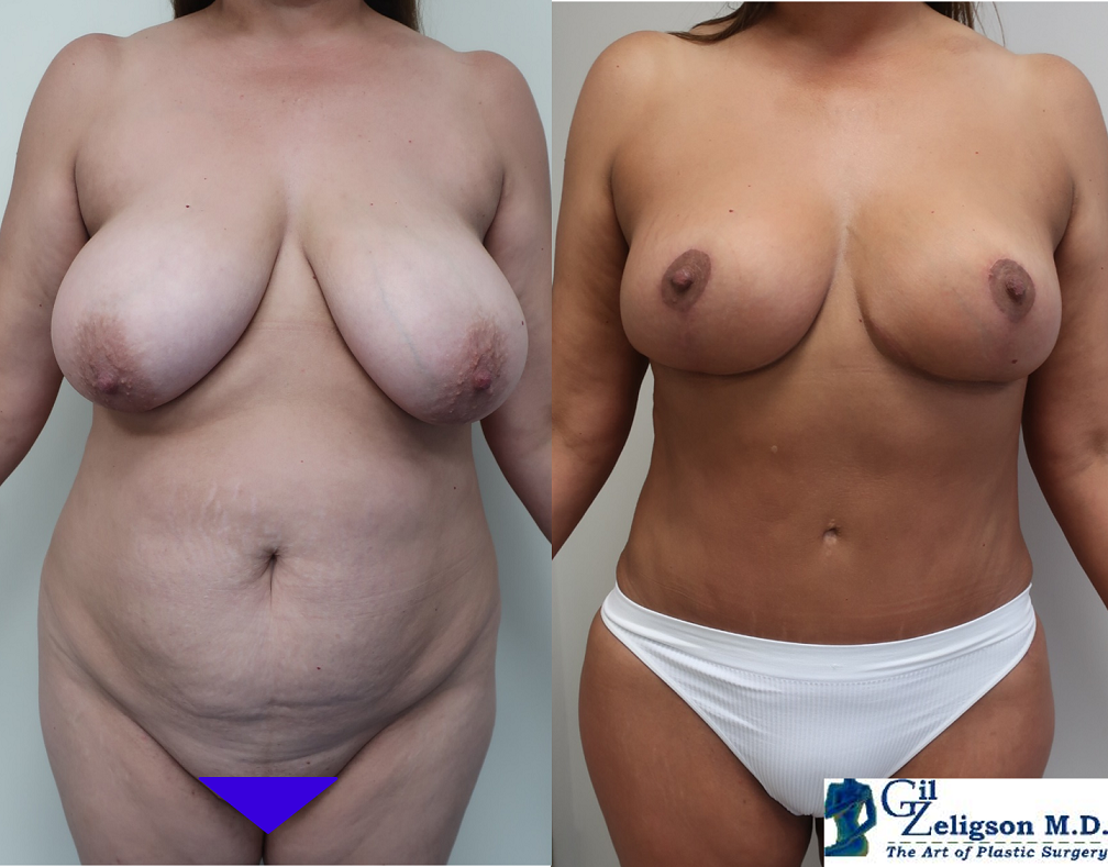 Dr. Gil Zeligson - Breast Reduction
