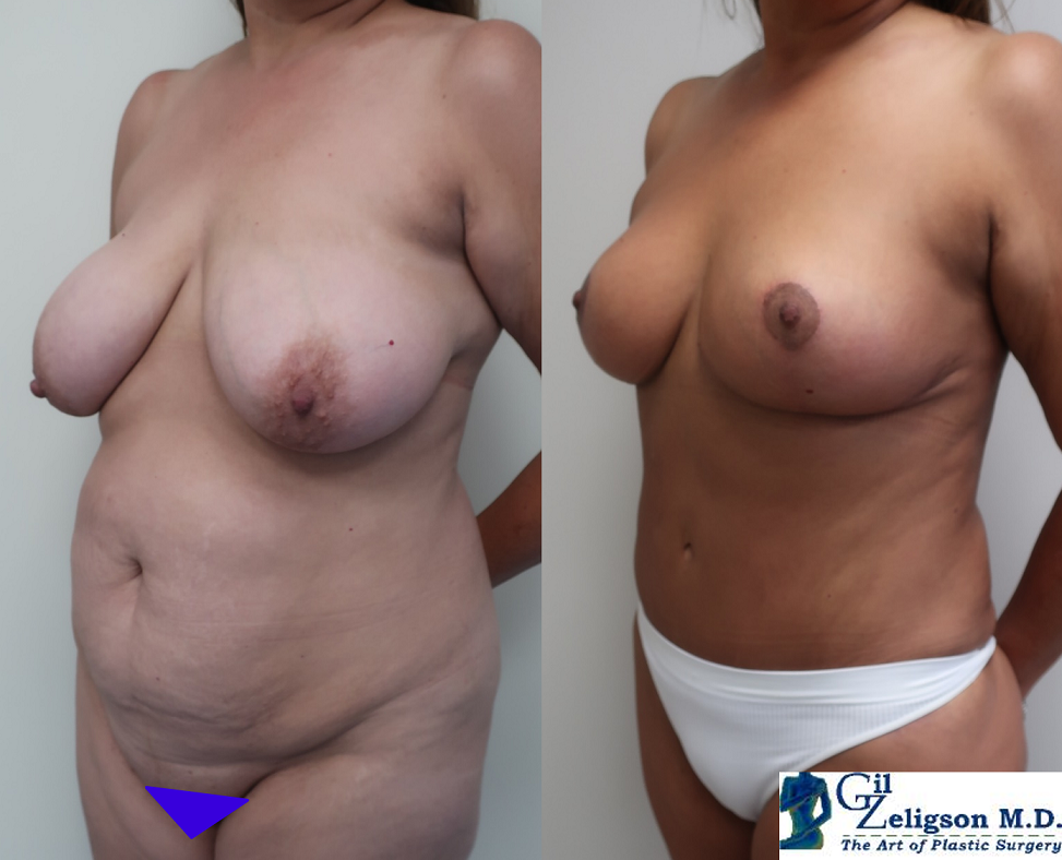 Dr. Gil Zeligson - Breast Reduction