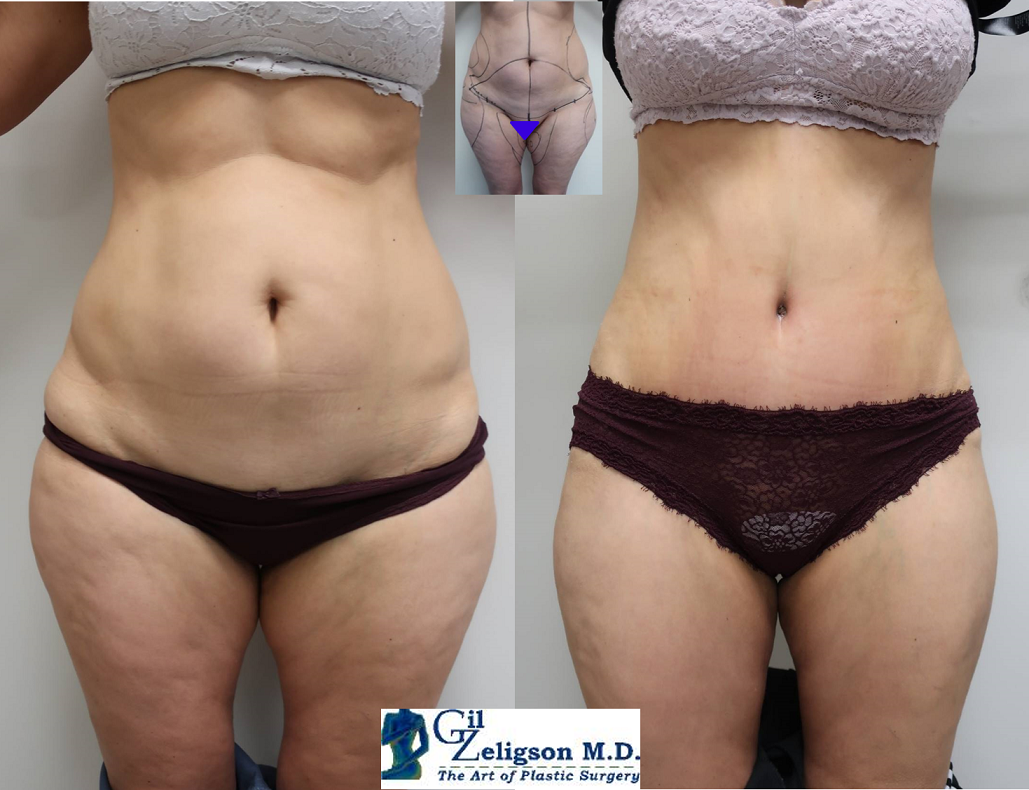 Dr. Gil Zeligson - Liposuction