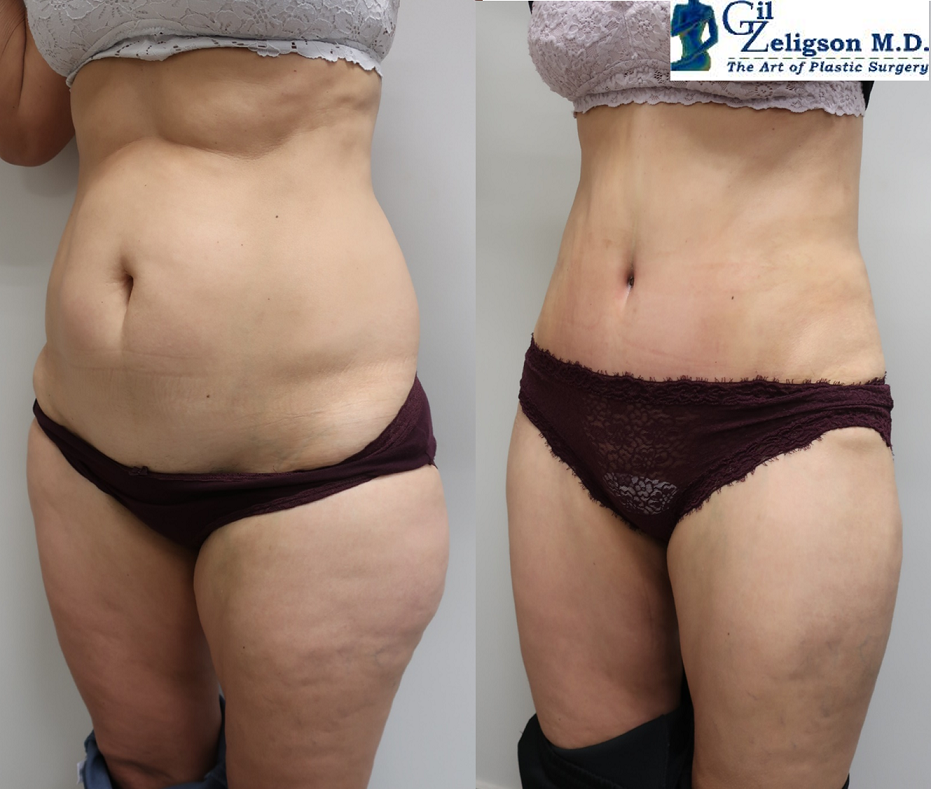 Dr. Gil Zeligson - Tummy Tuck Abdomino plasty