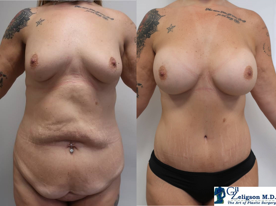 Dr. Gil Zeligson - Tummy Tuck Abdomino plasty