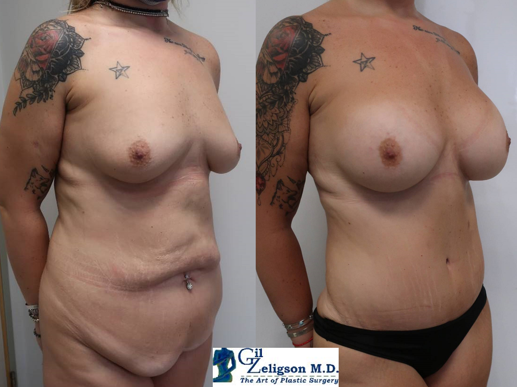 Dr. Gil Zeligson - Tummy Tuck Abdomino plasty