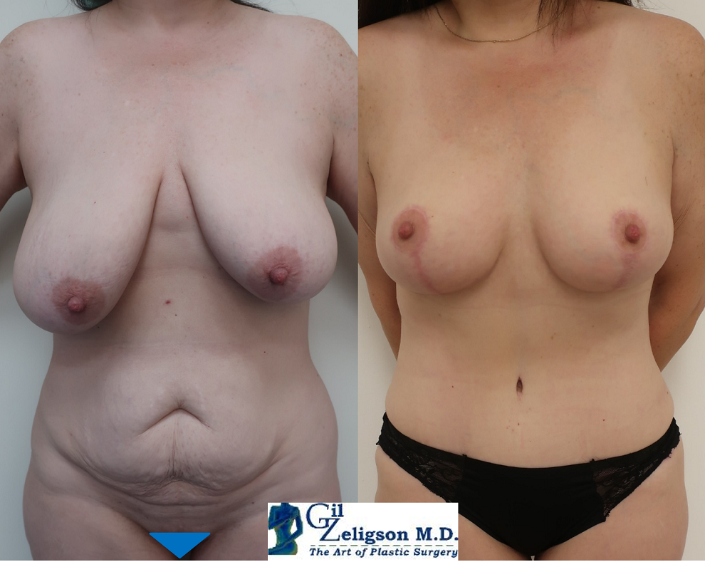 Dr. Gil Zeligson - Tummy Tuck Abdomino plasty