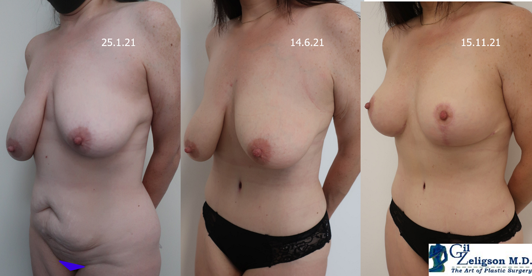 Dr. Gil Zeligson - Breast Asymmetry Correction