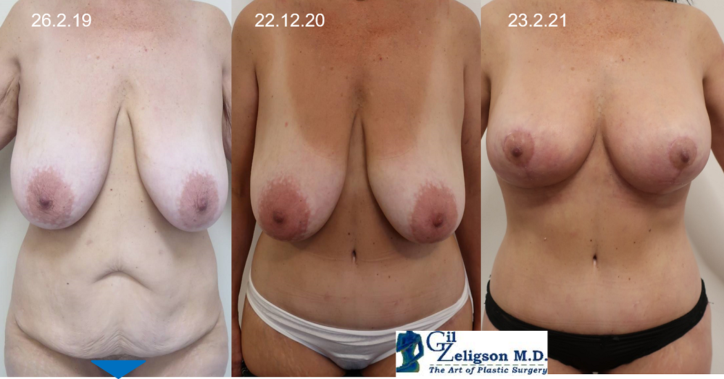 Dr. Gil Zeligson - Breast Reduction