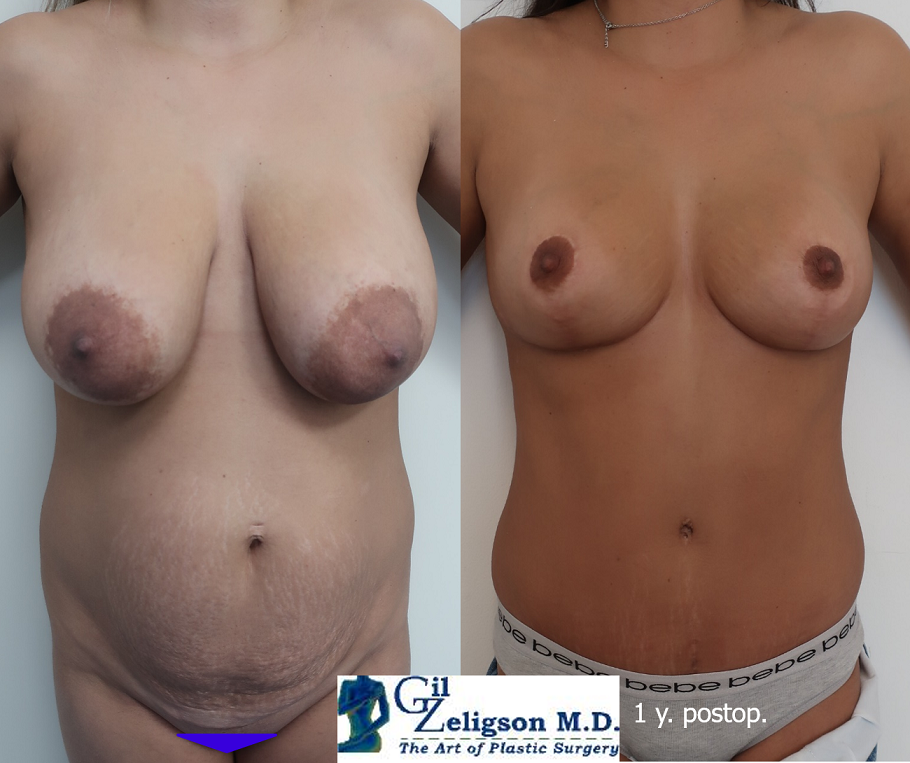 Dr. Gil Zeligson - Breast Reduction