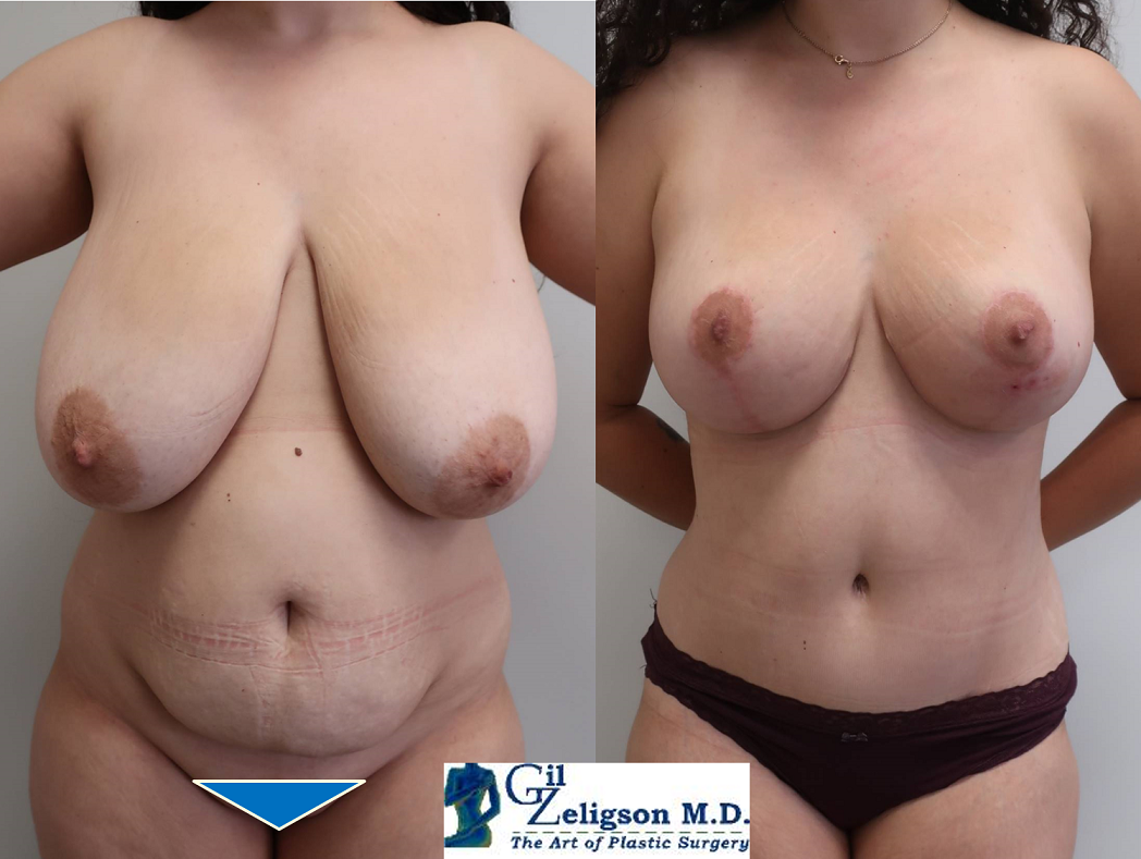 Dr. Gil Zeligson - Tummy Tuck Abdomino plasty