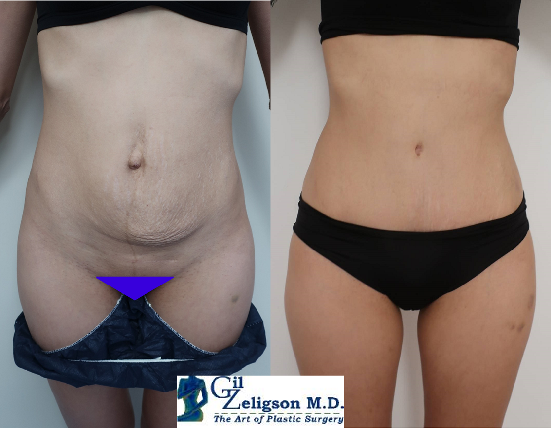 Dr. Gil Zeligson - Tummy Tuck Abdomino plasty