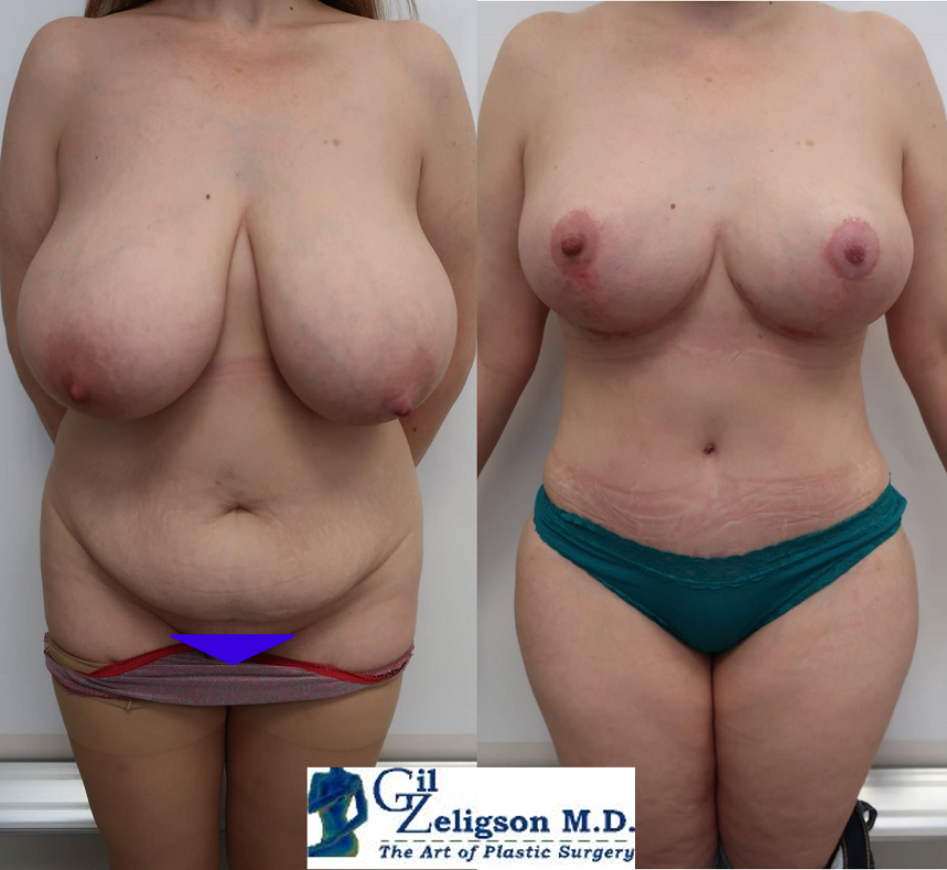 Dr. Gil Zeligson - Tummy Tuck Abdomino plasty