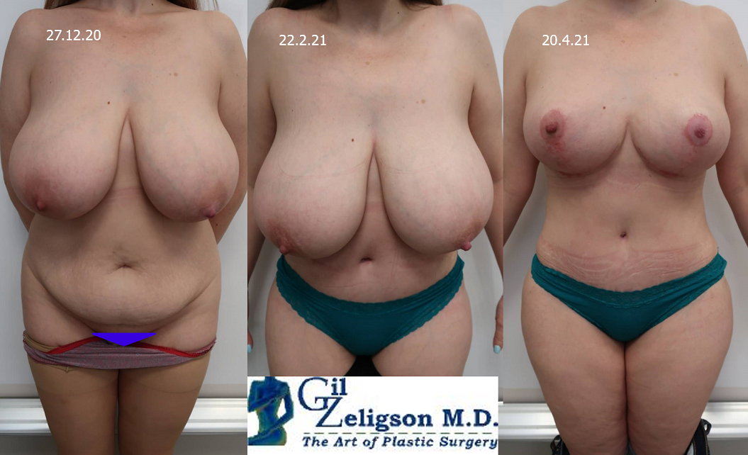 Dr. Gil Zeligson - Tummy Tuck Abdomino plasty