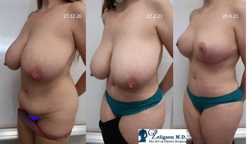 Dr. Gil Zeligson - Breast Reduction