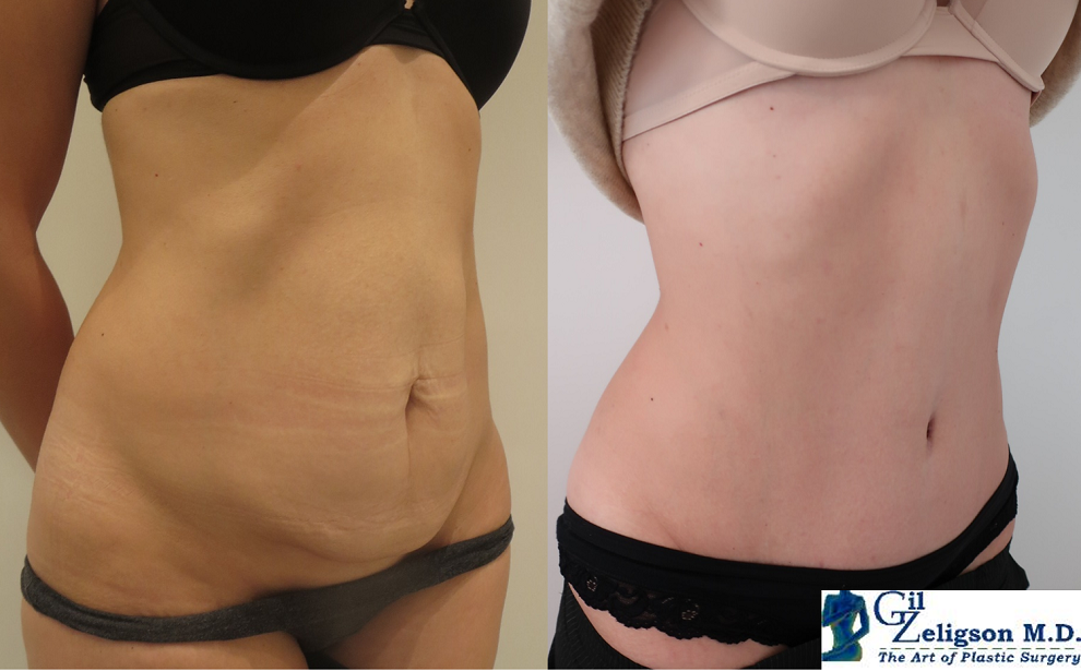 Dr. Gil Zeligson - Tummy Tuck Abdomino plasty