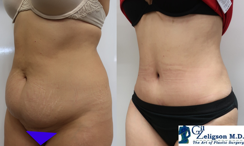 Dr. Gil Zeligson - Tummy Tuck Abdomino plasty