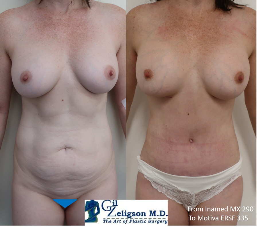 Dr. Gil Zeligson - Tummy Tuck Abdomino plasty