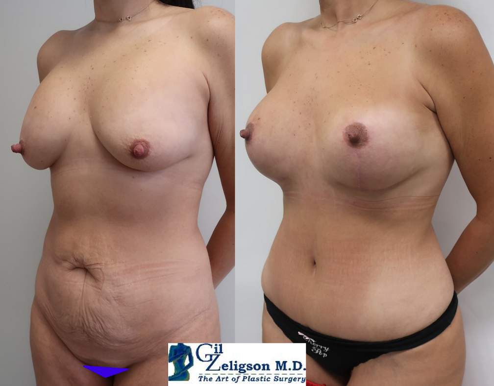 Dr. Gil Zeligson - Tummy Tuck Abdomino plasty