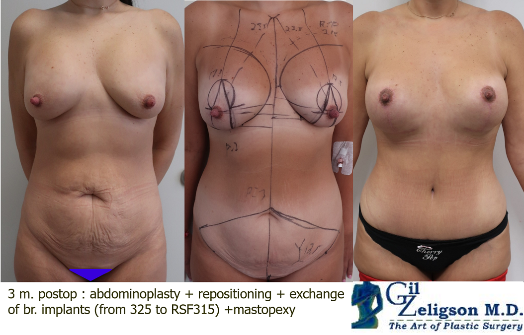Dr. Gil Zeligson - Tummy Tuck Abdomino plasty