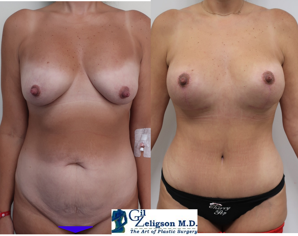 Dr. Gil Zeligson - Tummy Tuck Abdomino plasty