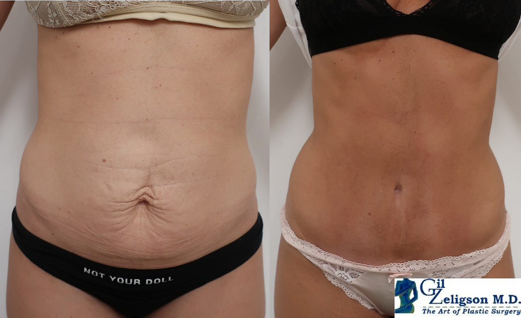Dr. Gil Zeligson - Tummy Tuck Abdomino plasty