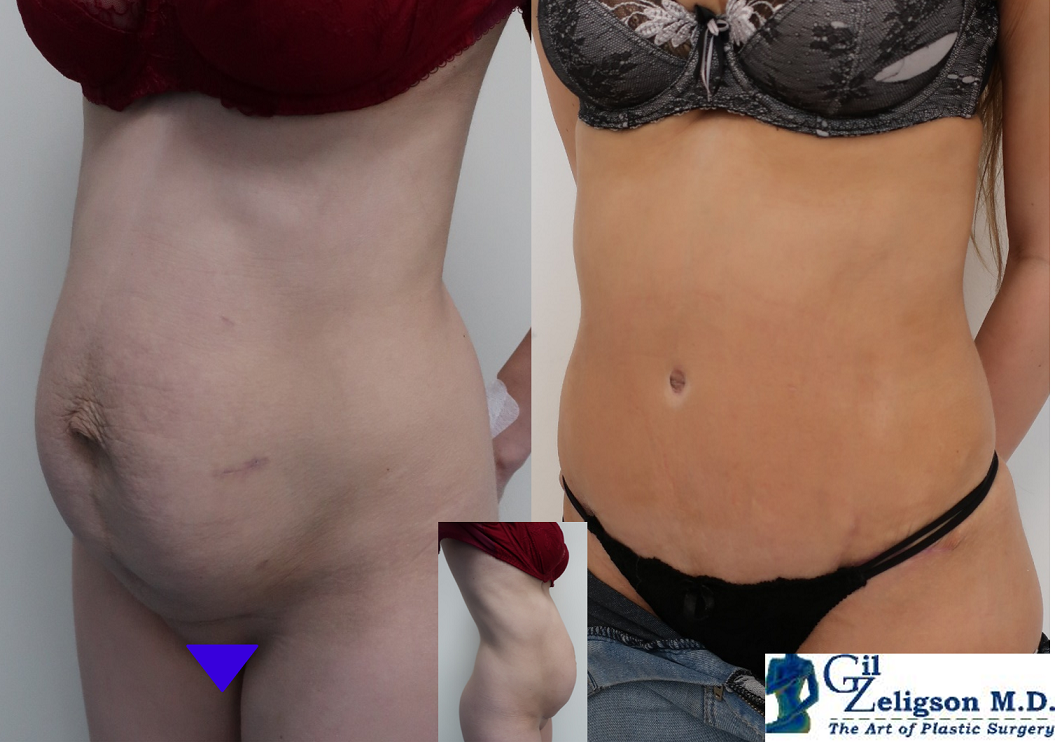 Dr. Gil Zeligson - Tummy Tuck Abdomino plasty