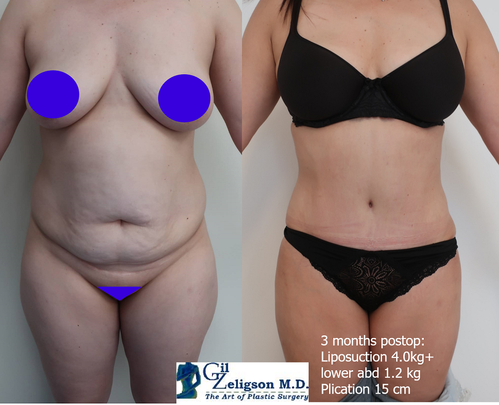 Dr. Gil Zeligson - Tummy Tuck Abdomino plasty