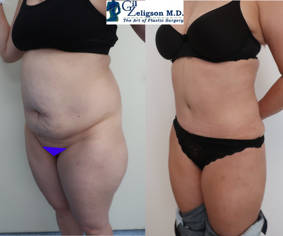 Dr. Gil Zeligson - Tummy Tuck Abdomino plasty