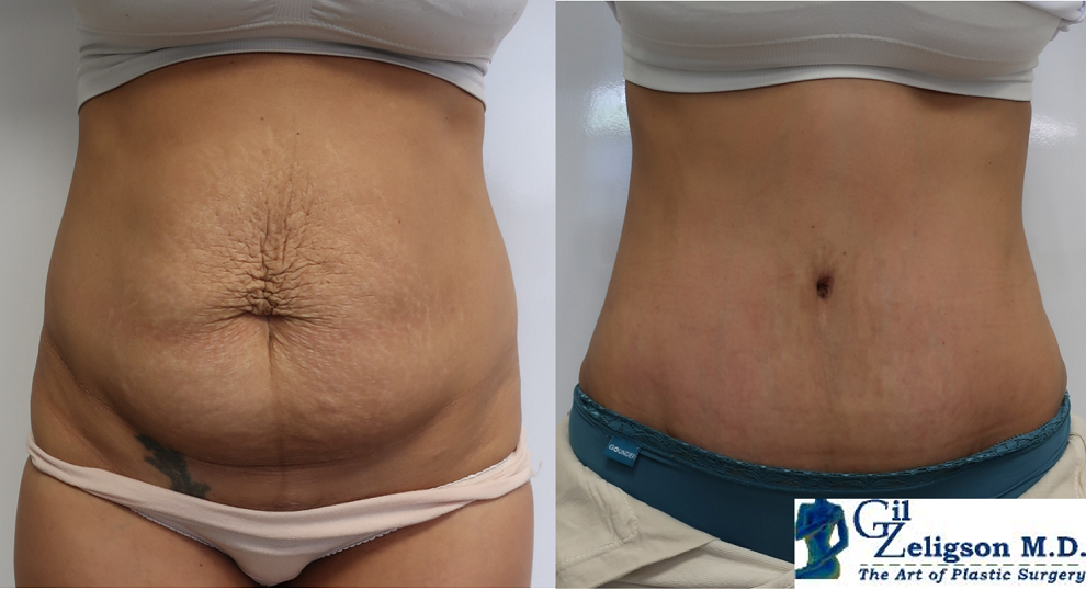Dr. Gil Zeligson - Tummy Tuck Abdomino plasty