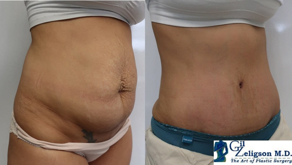 Dr. Gil Zeligson - Tummy Tuck Abdomino plasty