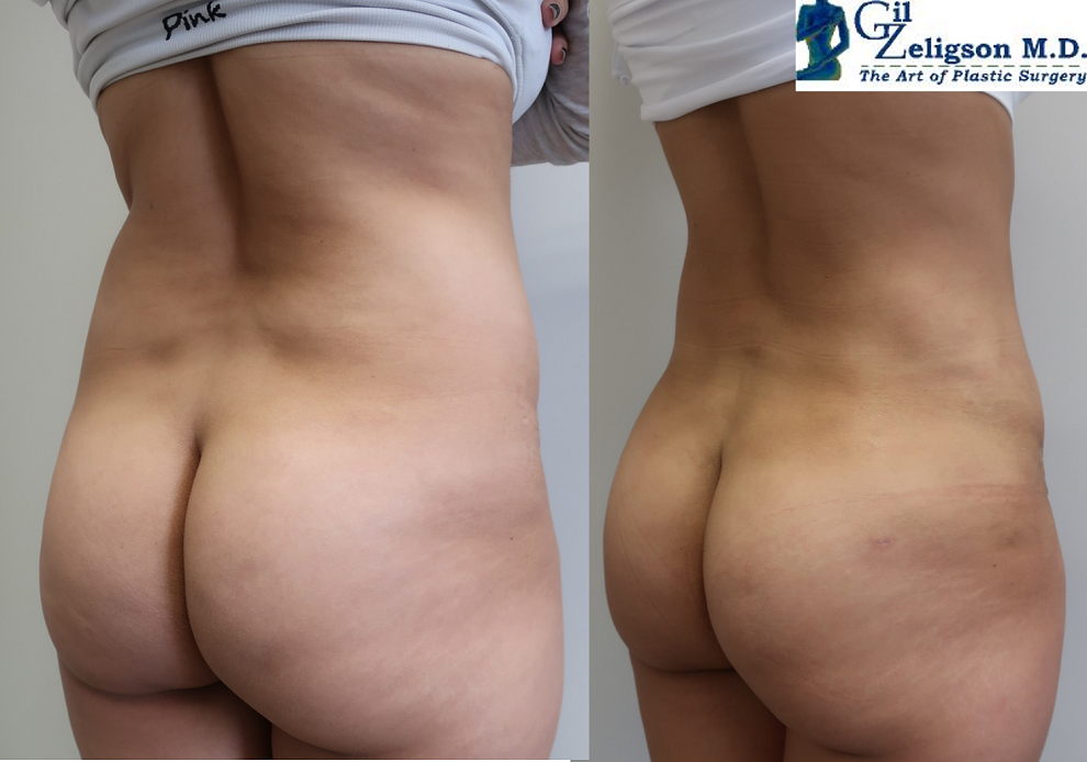 Dr. Gil Zeligson - Tummy Tuck Abdomino plasty