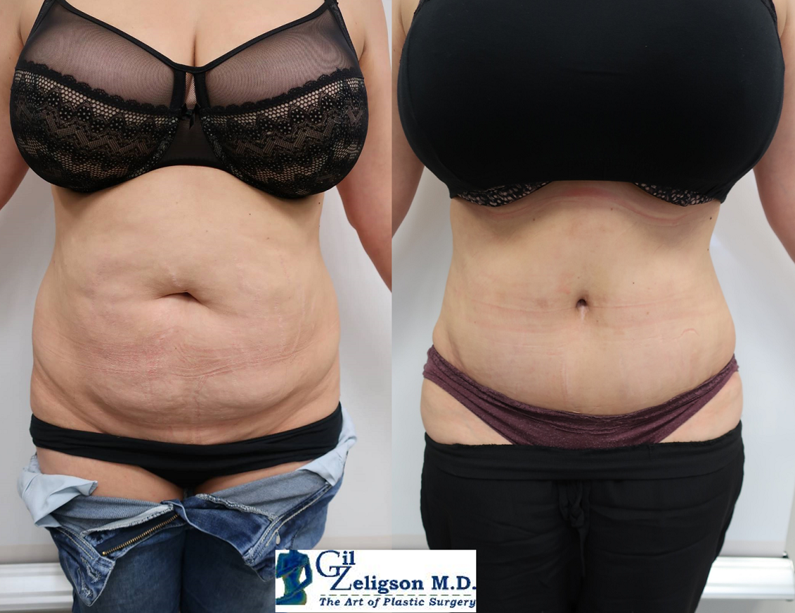 Dr. Gil Zeligson - Tummy Tuck Abdomino plasty