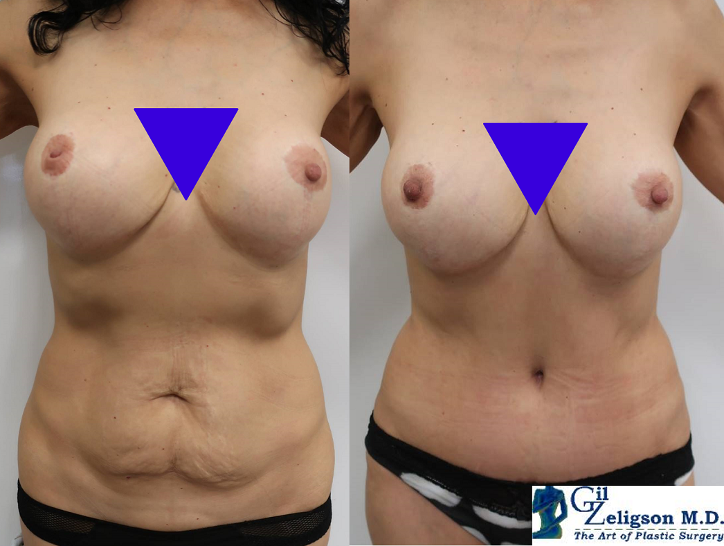 Dr. Gil Zeligson - Tummy Tuck Abdomino plasty