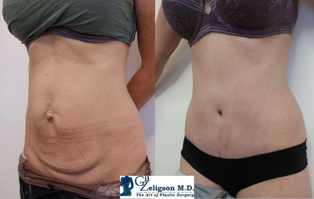 Dr. Gil Zeligson - Tummy Tuck Abdomino plasty