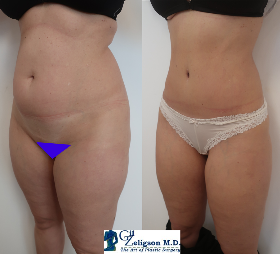 Dr. Gil Zeligson - Tummy Tuck Abdomino plasty
