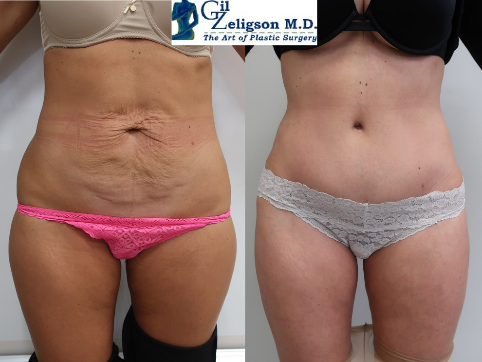 Dr. Gil Zeligson - Tummy Tuck Abdomino plasty