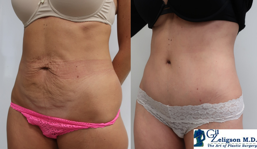 Dr. Gil Zeligson - Liposuction
