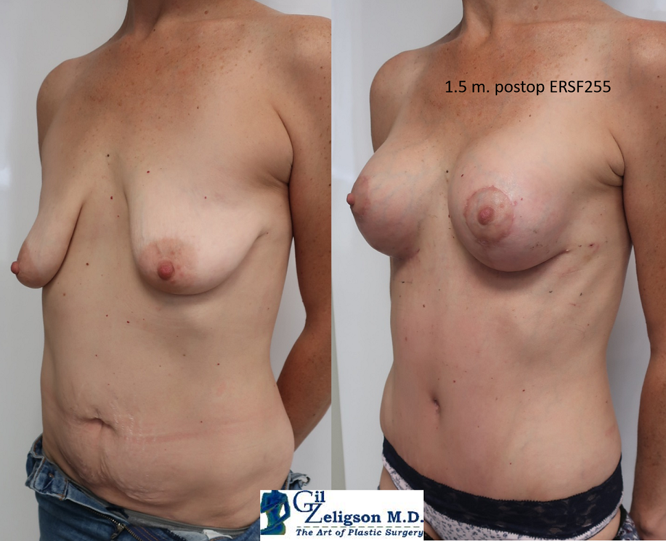 Dr. Gil Zeligson - Mastopexy + Augmentation
