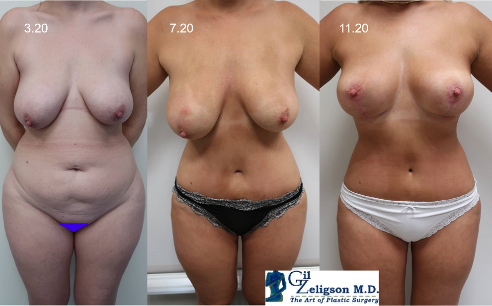 Dr. Gil Zeligson - Tummy Tuck Abdomino plasty