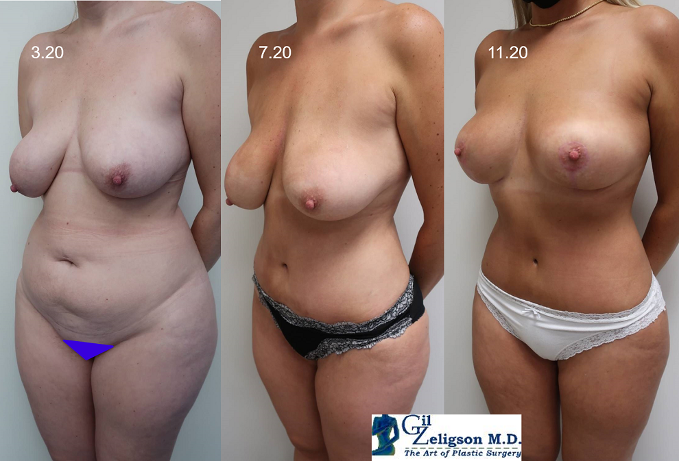 Dr. Gil Zeligson - Tummy Tuck Abdomino plasty