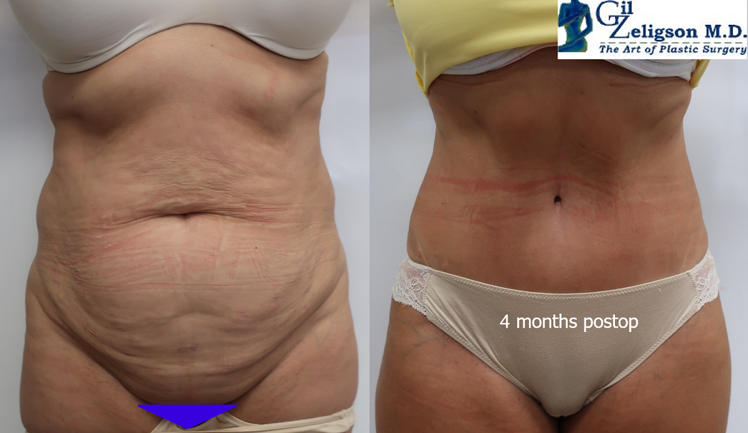 Dr. Gil Zeligson - Tummy Tuck Abdomino plasty