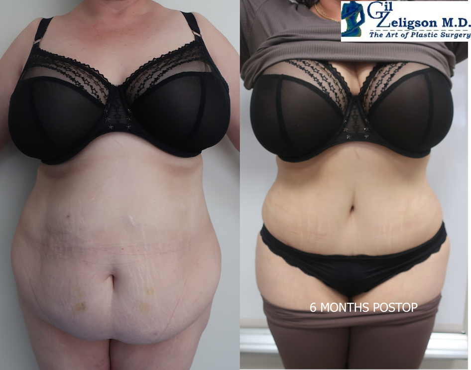 Dr. Gil Zeligson - Tummy Tuck Abdomino plasty