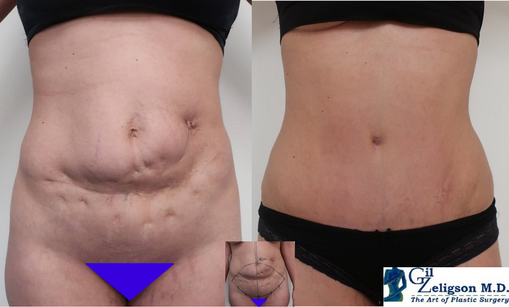 Dr. Gil Zeligson - Tummy Tuck Abdomino plasty