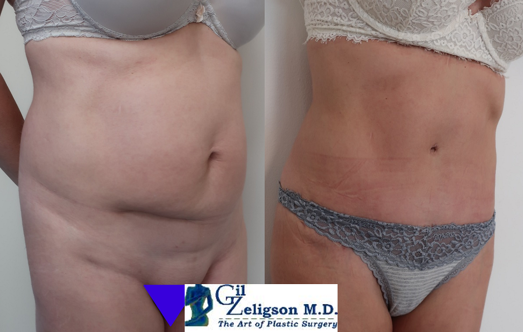 Dr. Gil Zeligson - Tummy Tuck Abdomino plasty