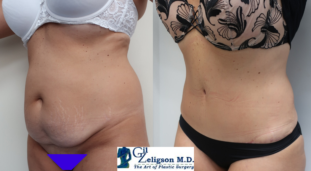 Dr. Gil Zeligson - Tummy Tuck Abdomino plasty