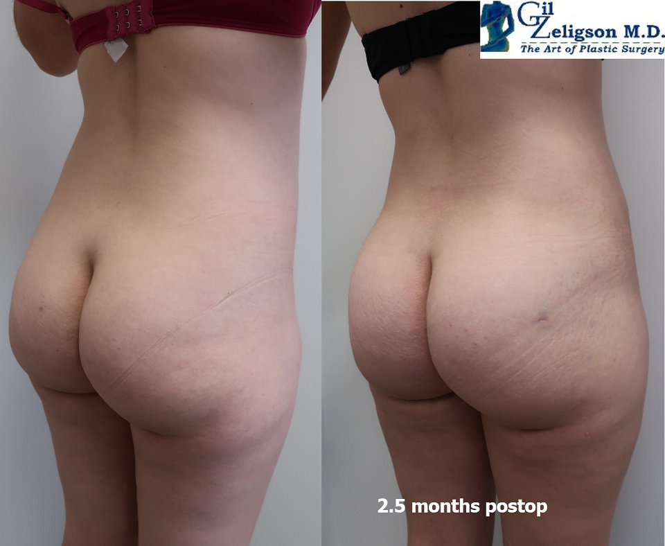 Dr. Gil Zeligson - Liposuction